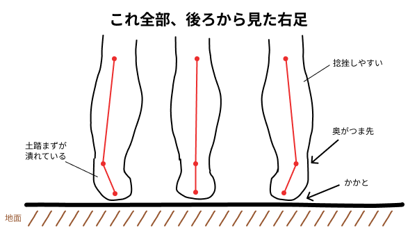 over pronation